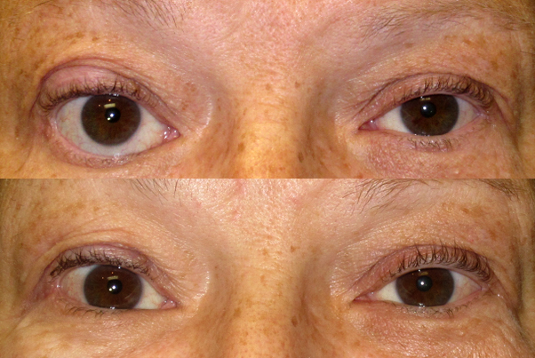 Before (upper) photo and After TarSys implant on the lower eyelid